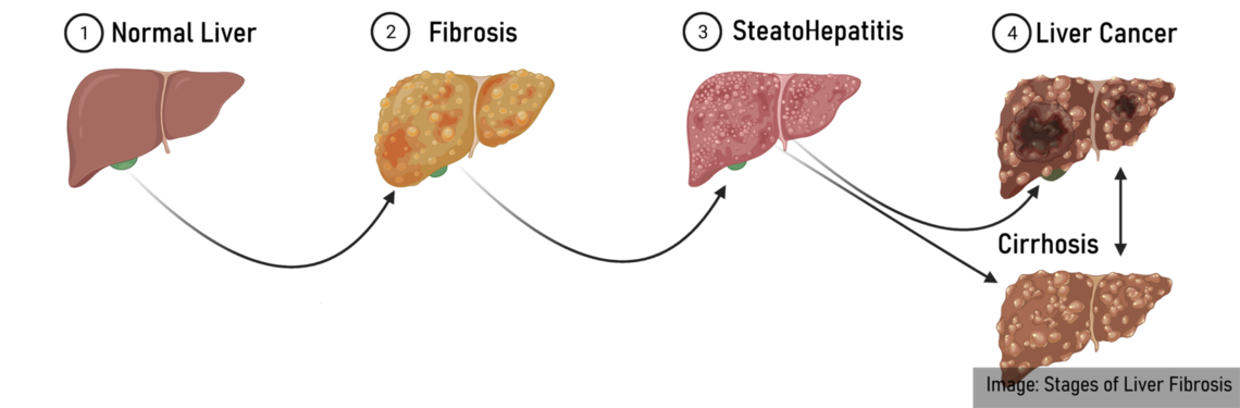 fibrosis